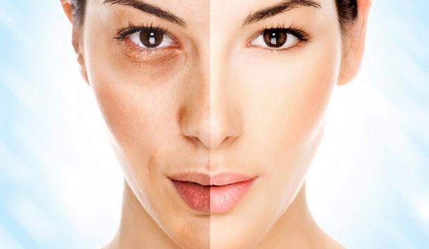 Güneş yanığı nasıl geçer? Güneş yanığına ne iyi gelir? Doğal tedavi!