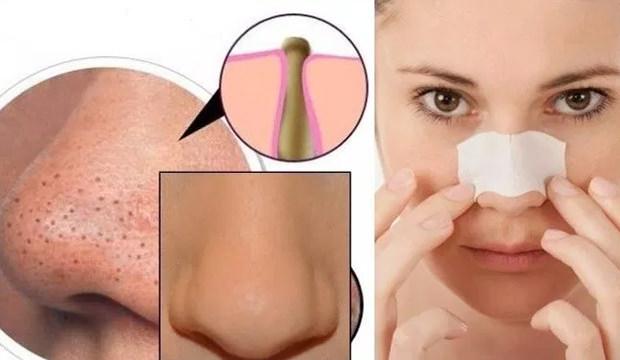 Evde siyah nokta temizleme! Kesin çözüm doğal siyah nokta maskeleri