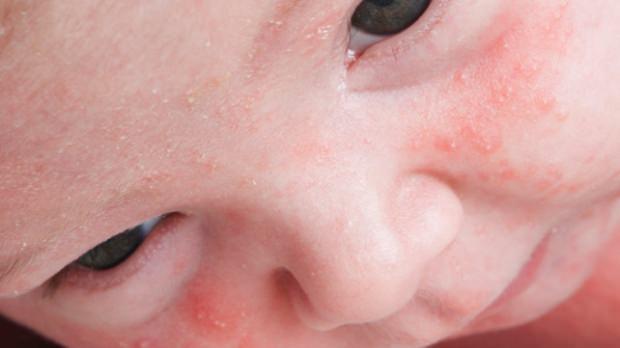 Bebegin Yuzundeki Sivilceler Nasil Gecer Sivilce Milia Kurutma Yontemleri Bebek Haberleri