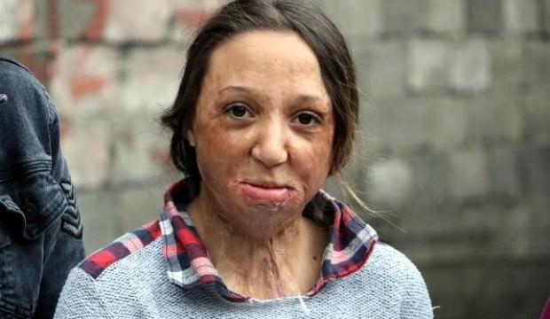 Vücudu ve yüzü yanan Yağmur, yardım bekliyor