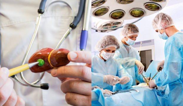 Safra Kesesi İltihabı nasıl kurutulur, bitkisel tedavi! Tedavi edilmezse