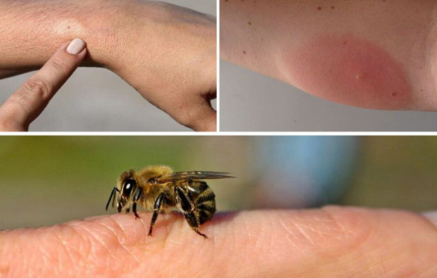 arı alerjisi belirtileri