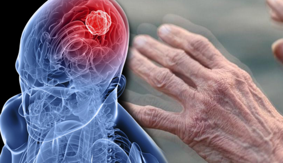 parkinson_hastaligi_nedir_parkinsonun_belirtileri_nelerdir_parkinson_nasil_tedavi_edilir_1563891649_0117.png