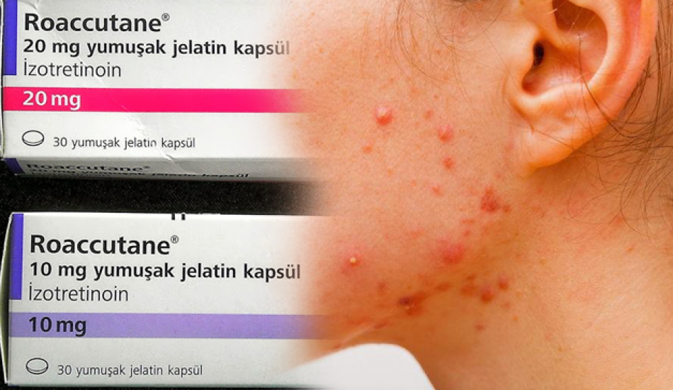 roaccutane_nedir_nasil_kullanilir_roaccutane_yan_etkileri_nasil_gecer_1564046142_007.png