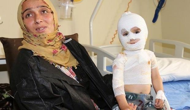 Üzerine kaynar su dökülen minik çocuk gün sayıyor