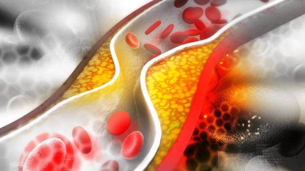 kolesterol belirtileri nelerdir