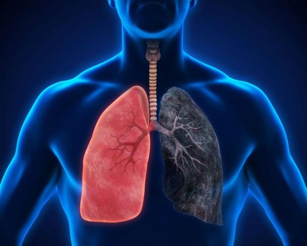 akciğer kanseri nedir