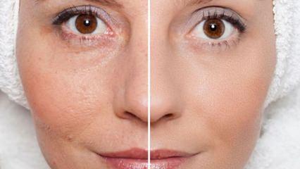 Dermapen uygulaması nedir Hangi tedavilerde kullanılır 59