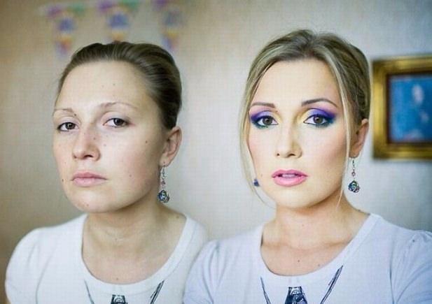 Klinefelter Erkek Özellikleri Klinefelter Sendromu Olanın Çocuğu Olurmu 40