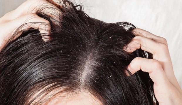 Saçta kepek neden olur? Kepek nasıl geçer, belirtileri tedavisi nedir