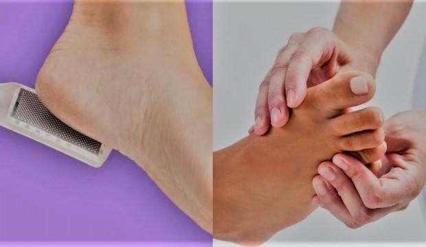İltihaplı nasır nasıl geçer El ve ayaktaki nasır için evde kesin