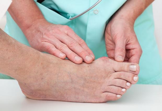 Ayak parmak bozukluğu ve ayak baş parmağındaki kemik çıkıntısı nedir? Ayak parmak bozukluğu tedavi edilir mi?