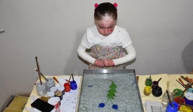 Kelebek hastası Ayşenur sanatla hayata tutunuyor