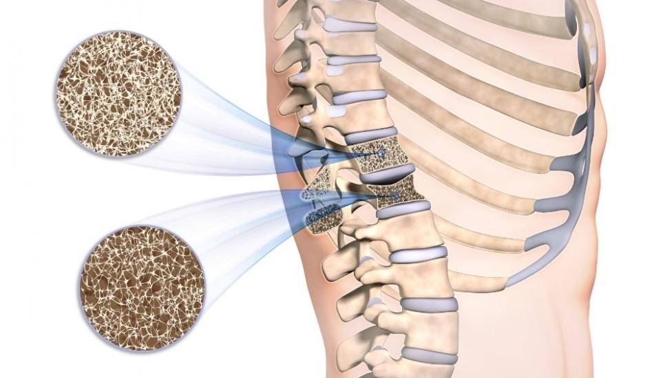 kemik_erimesi_osteoporoz_nedir_kemik_erimesi_belirtileri_nelerdir_ve_tedavisi_var_midir_1571836172_0064.jpg