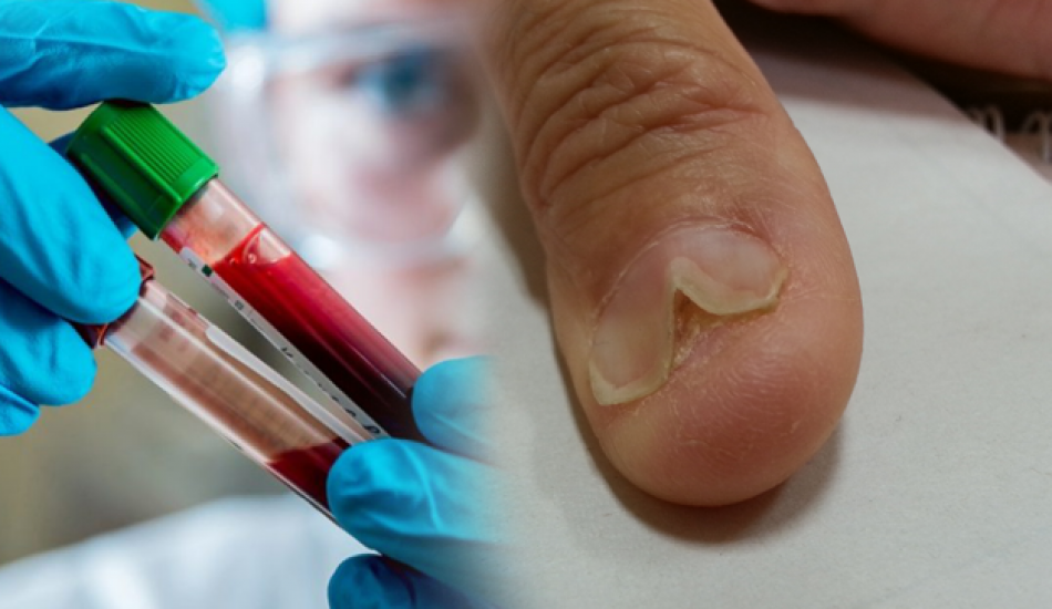 ferritin_eksikligi_nedir_ferritin_eksikliginin_belirtileri_nelerdir_ferritin_iceren_besinler_nelerdir_1574087744_101.png