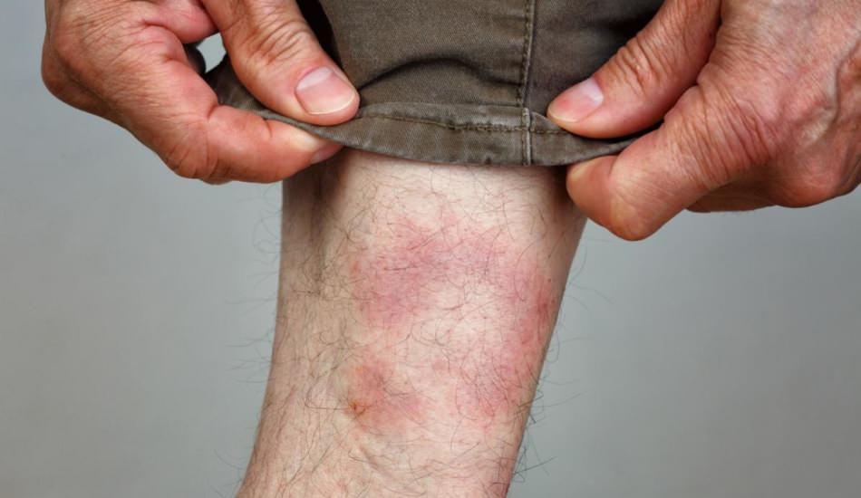 lyme_hastaligi_nasil_ortaya_cikar_lyme_belirtileri_nelerdir_lyme_hastaligi_tedavisi_var_midir_1578662541_838.jpg