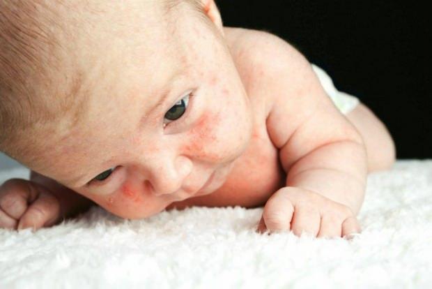 Bebekler için cilt bakım önerileri! Bebeklerde görülen cilt problemleri neler?