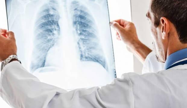 Zatürre belirtileri nelerdir? Zatürrenin nedenleri ve tedavi yöntemleri