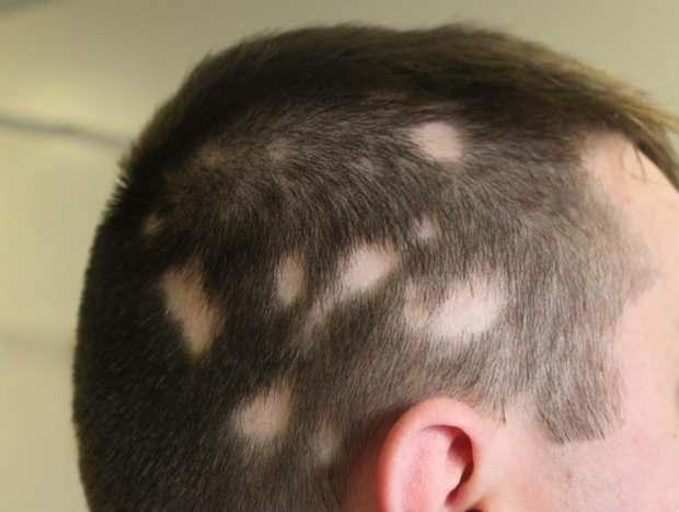 Saçkıran (Alopesi areata) nedir? Saçkıran belirtileri neler? Saçkıran için etkili çözümler