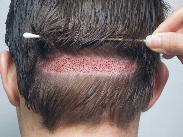 Saçkıran (Alopesi areata) nedir? Saçkıran nasıl geçer? Saçkıran için etkili çözümler