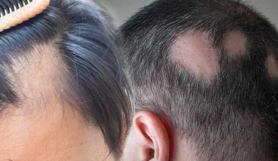 sackiran_alopesi_areata_nedir_sackiran_nasil_gecer_sackiran_icin_etkili_cozumler_1580113870_7483.jpg