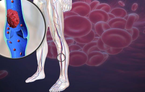 bacak damarlarındaki azalan kan dolaşımı ağrıya neden olur