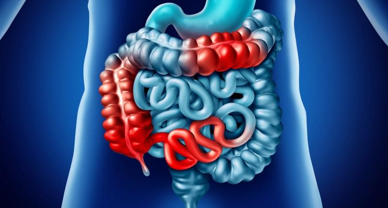 Crohn hastalığı nedir? Crohn hastalığının belirtileri nelerdir & Tedavisi