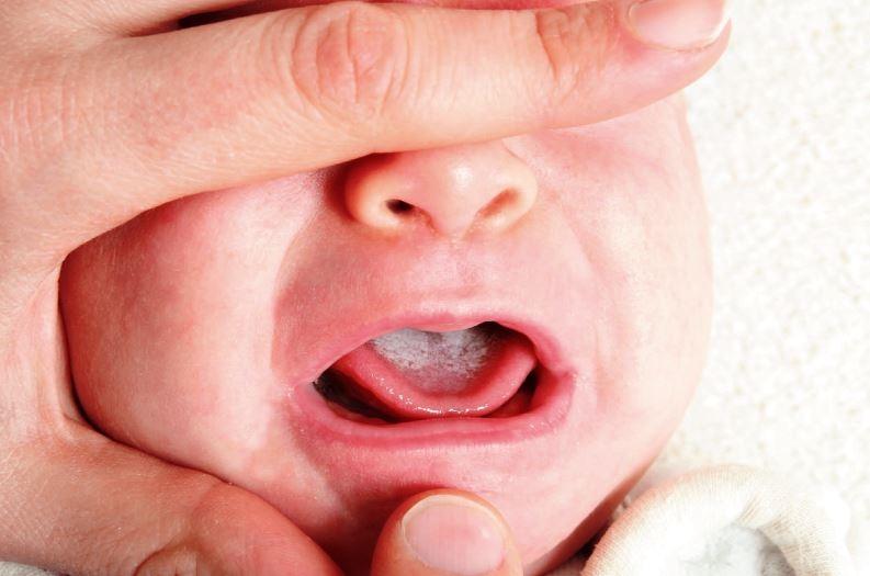 etkili bir sekilde faktor piyango bebeklerde damak beyazligi lonegrovedentist com