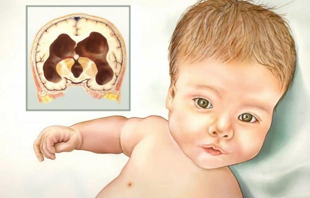 Bebeklerde hidrosefali ve mikrosefali nedir? Anne karnında bebeğin beyninde su toplaması