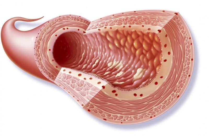 crohn tüm sindirimin iltihaplanmasına yol açar