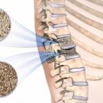 Kemik erimesi (Osteoporoz) nedir? Kemik erimesi belirtileri nelerdir ve tedavisi var mıdır?