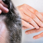 Atopik Dermatit (Egzama) nedir? Egzama en kolay nasıl geçer? Saç ve cilt egzaması...