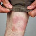 Lyme hastalığı nasıl ortaya çıkar? Lyme belirtileri nelerdir? Lyme hastalığı tedavisi var mıdır?